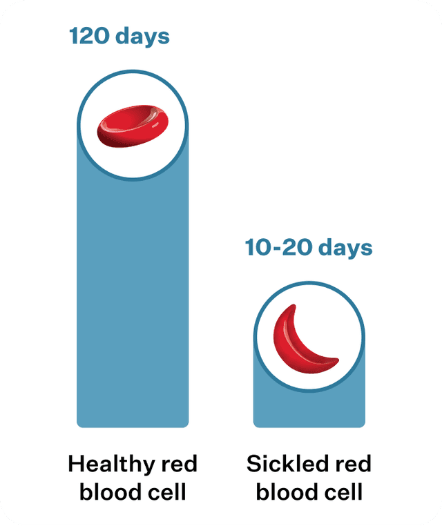 Comparison of healthy and sickled red blood cell lifespans, showing a healthy red blood cell lasting 120 days and a sickled red blood cell lasting 10-20 days