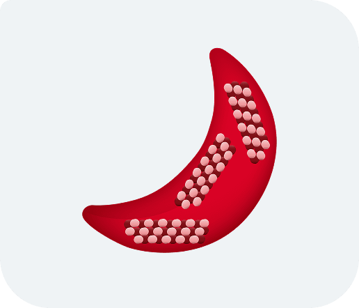 Illustration of a sickled red blood cell with hemoglobin rods inside