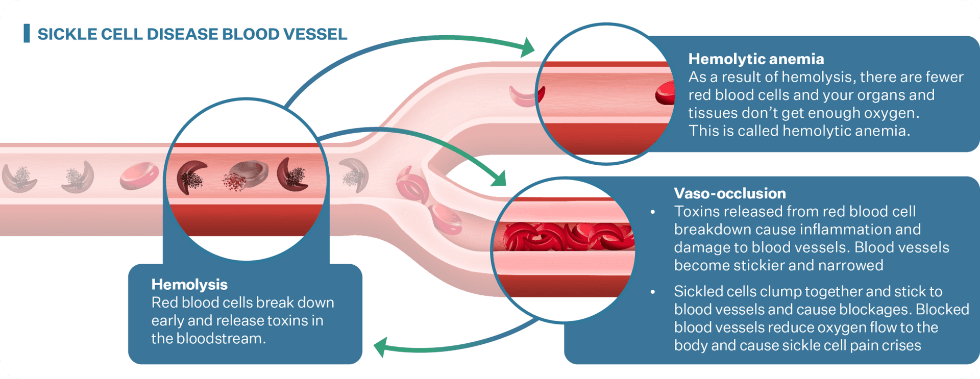 Image of blood vessels in sickle cell disease that shows that hemolysis, early red blood cell breakdown, leads to hemolytic anemia and blockages (vaso-occlusions)