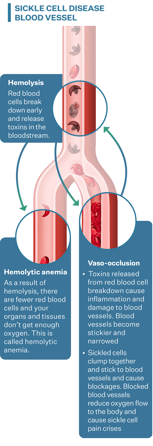 Image of blood vessels in sickle cell disease that shows that hemolysis, early red blood cell breakdown, leads to hemolytic anemia and blockages (vaso-occlusions)