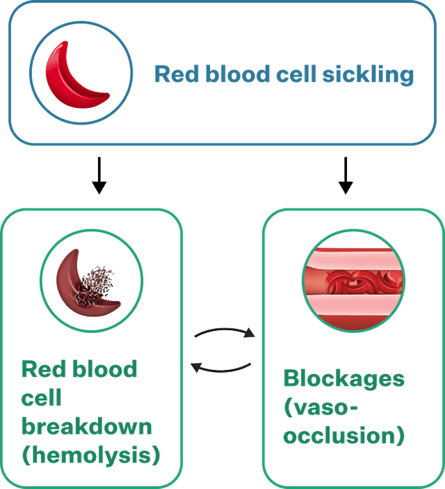 Flow diagram connecting red blood cell sickling, hemolysis, and vaso-occlusion